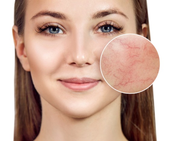 Vascular Lesion Treatment